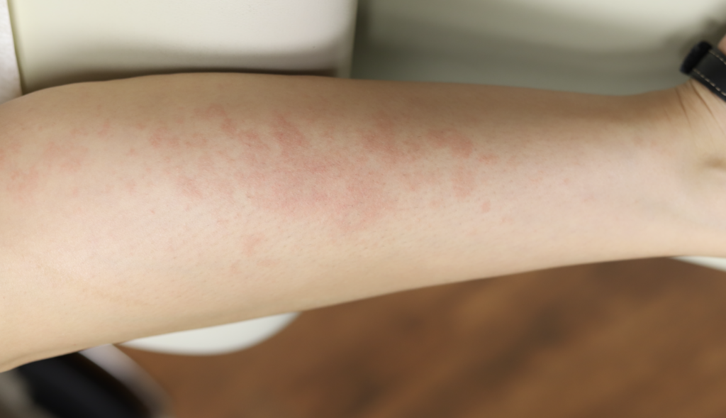 Postpartum hives