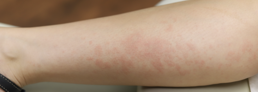 Postpartum hives