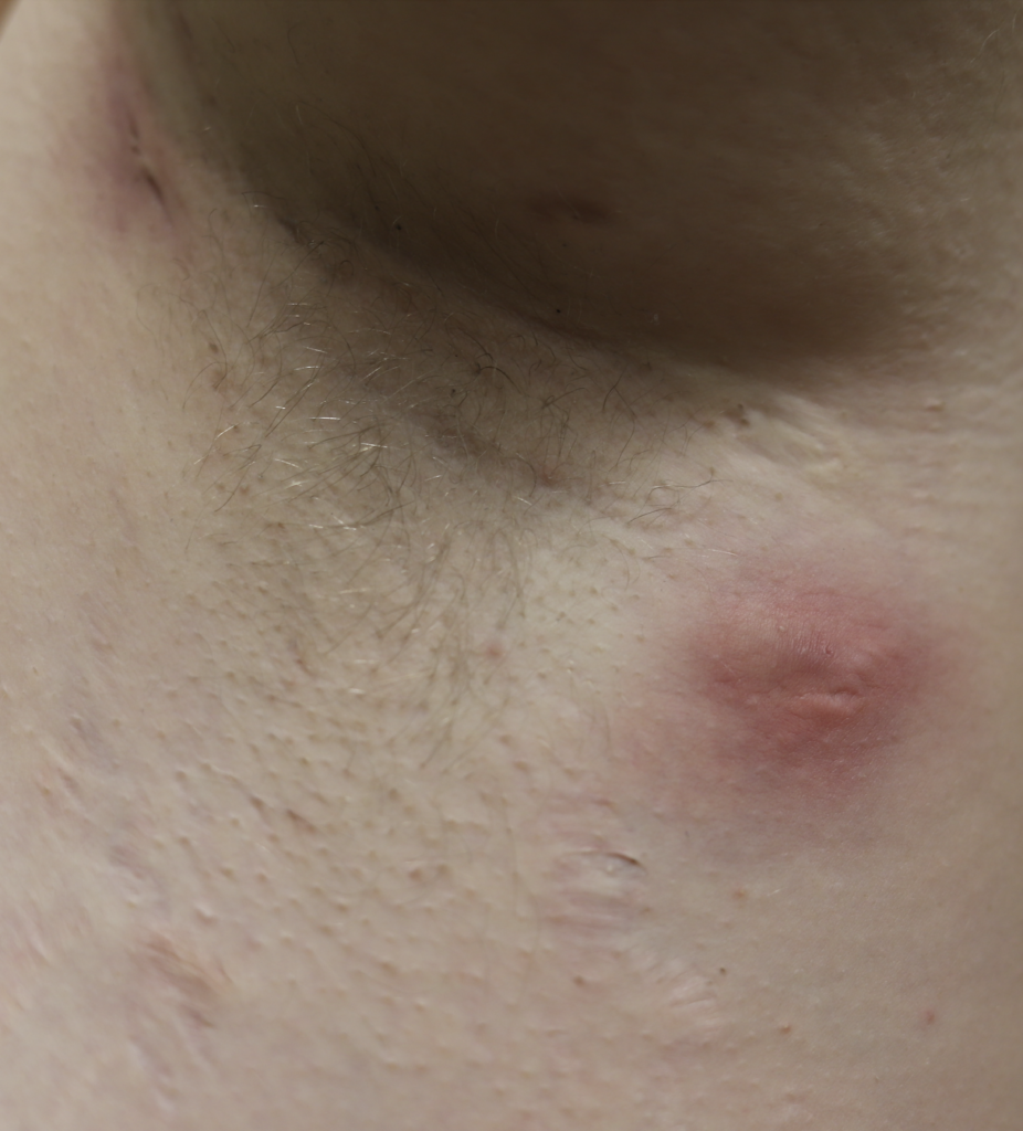 Hidradenitis Suppurativa in axilla