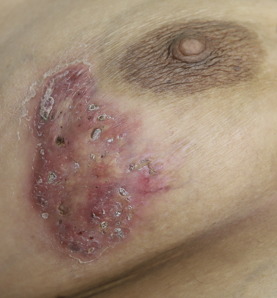Hidradenitis Suppurativa on breast