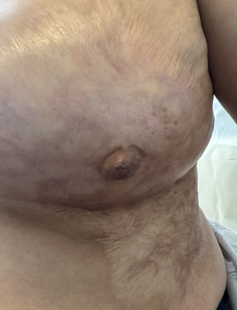 burns on breast, burns and breastfeeding