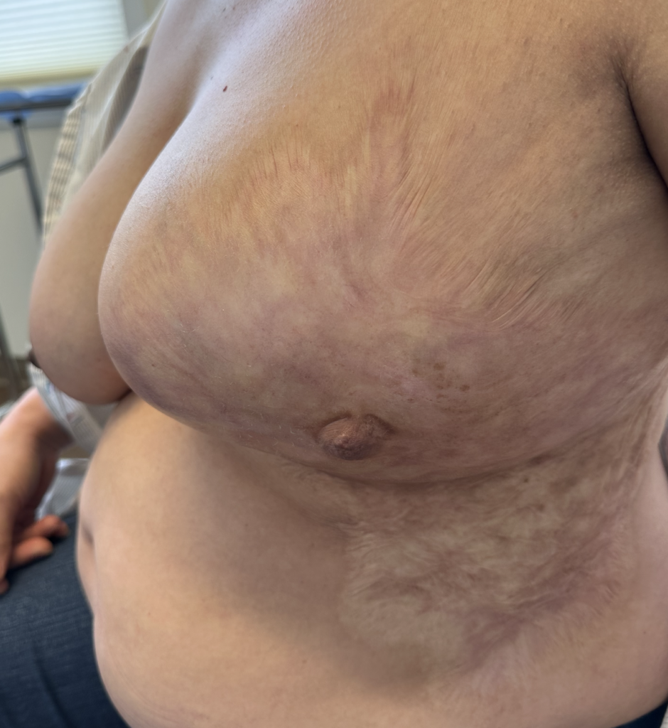 burns on breast, burns and breastfeeding