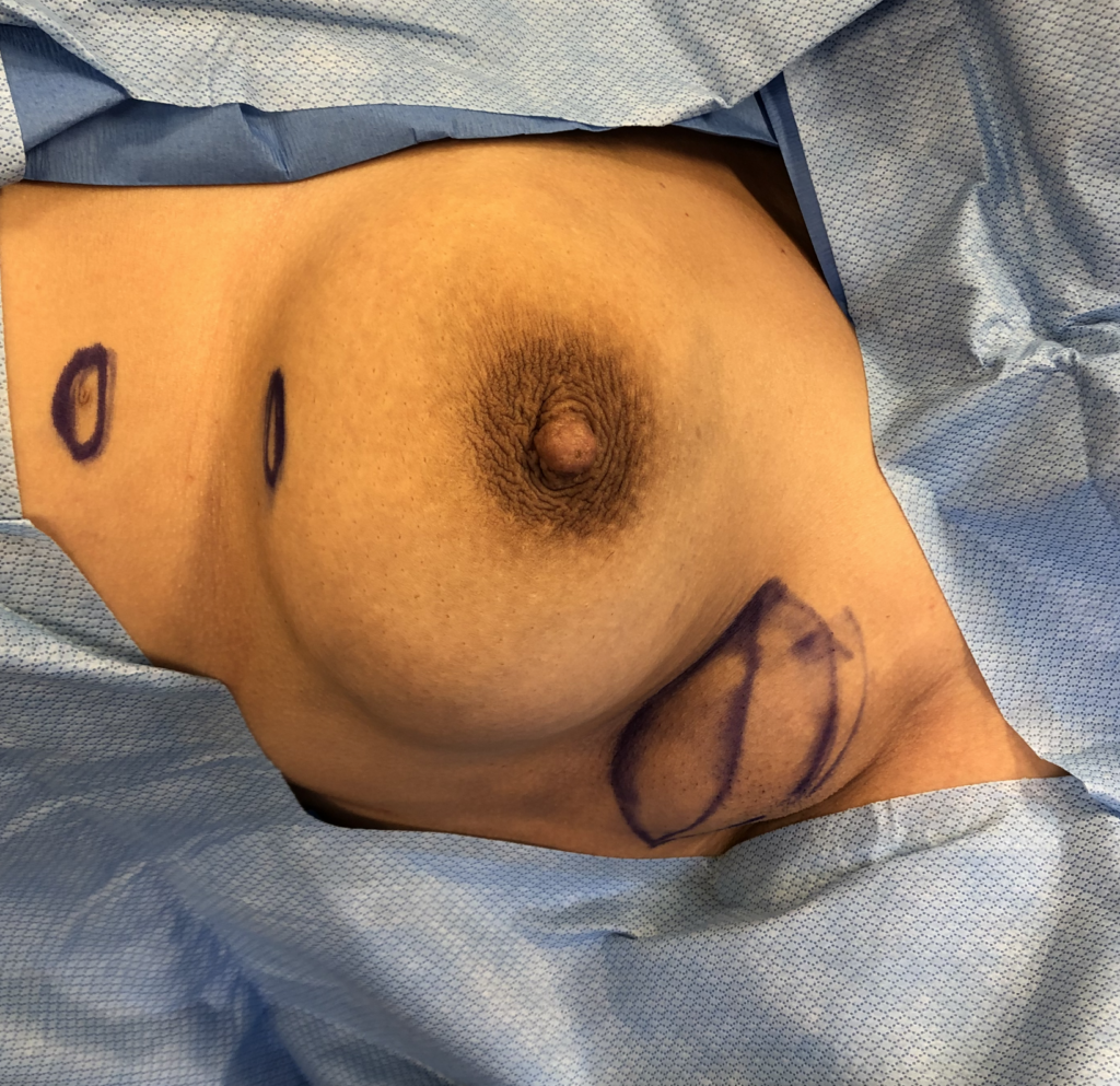 accessory breast tissue