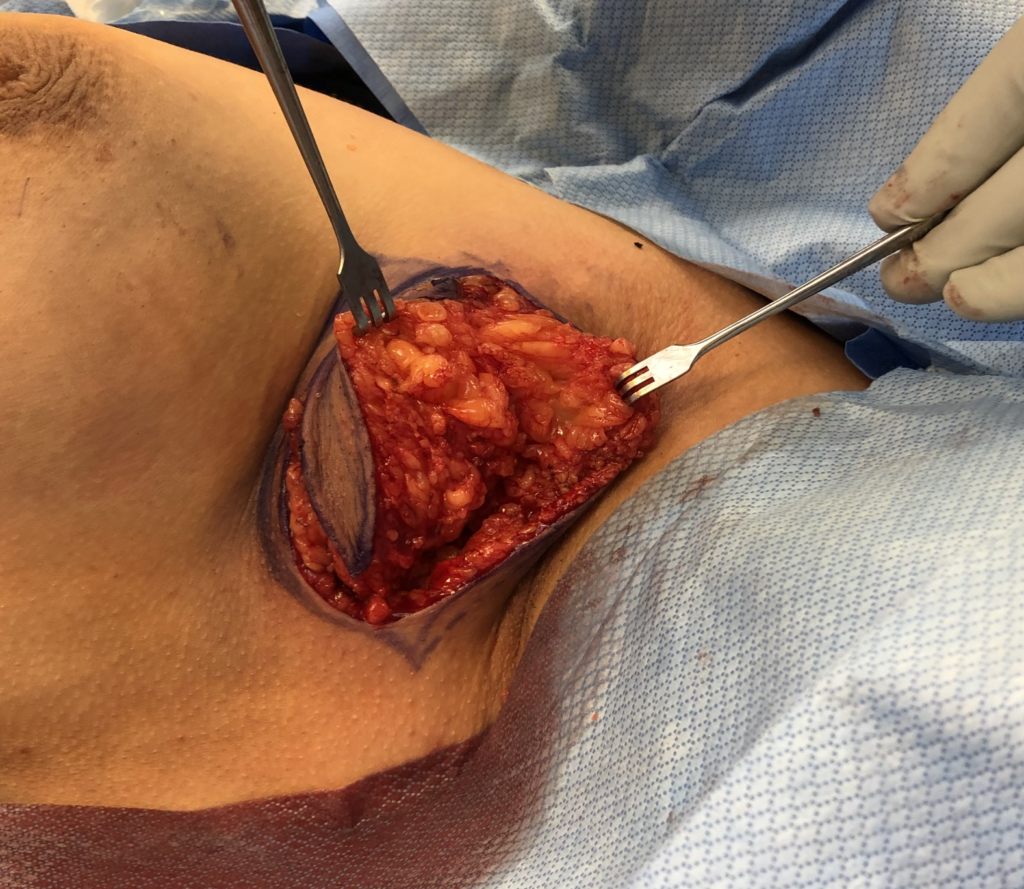 excision of accessory breast tissue