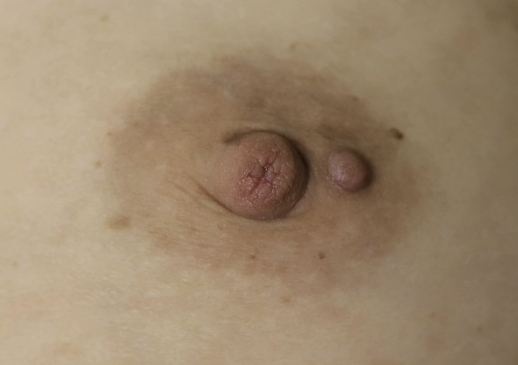 Keloid scar on left areola