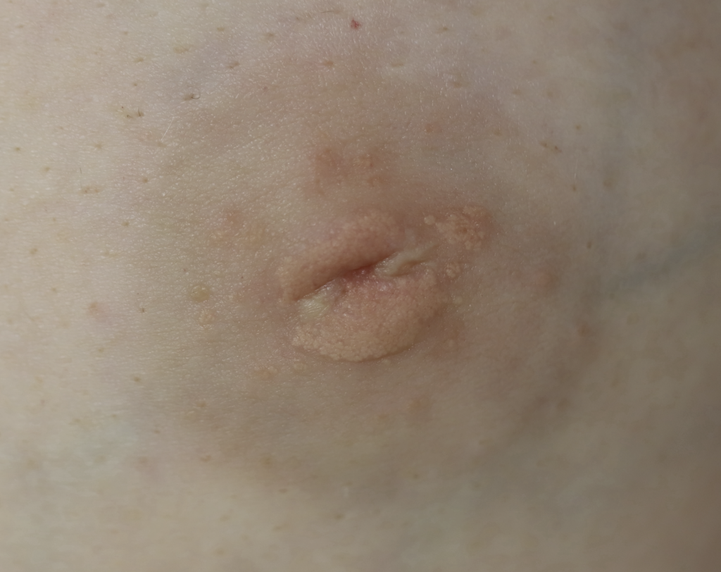Lack of nipple development with smooth nipple and areola