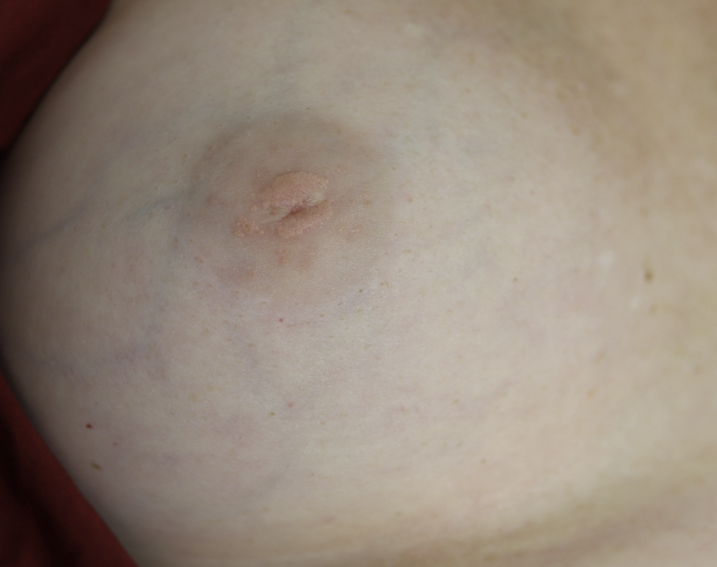 Lack of nipple development with smooth nipple and areola