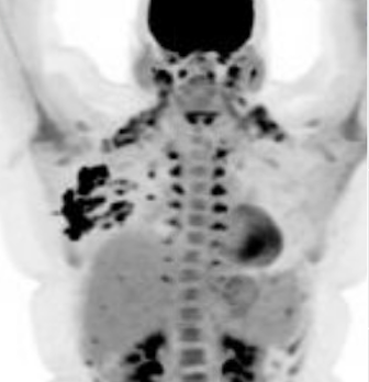 IGM 3 months postpartum weaned