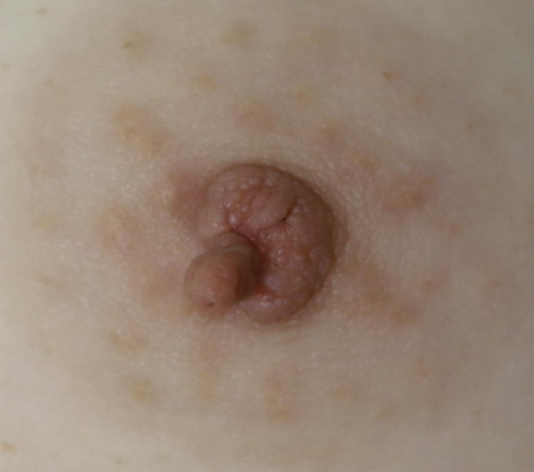 Skin tag left nipple