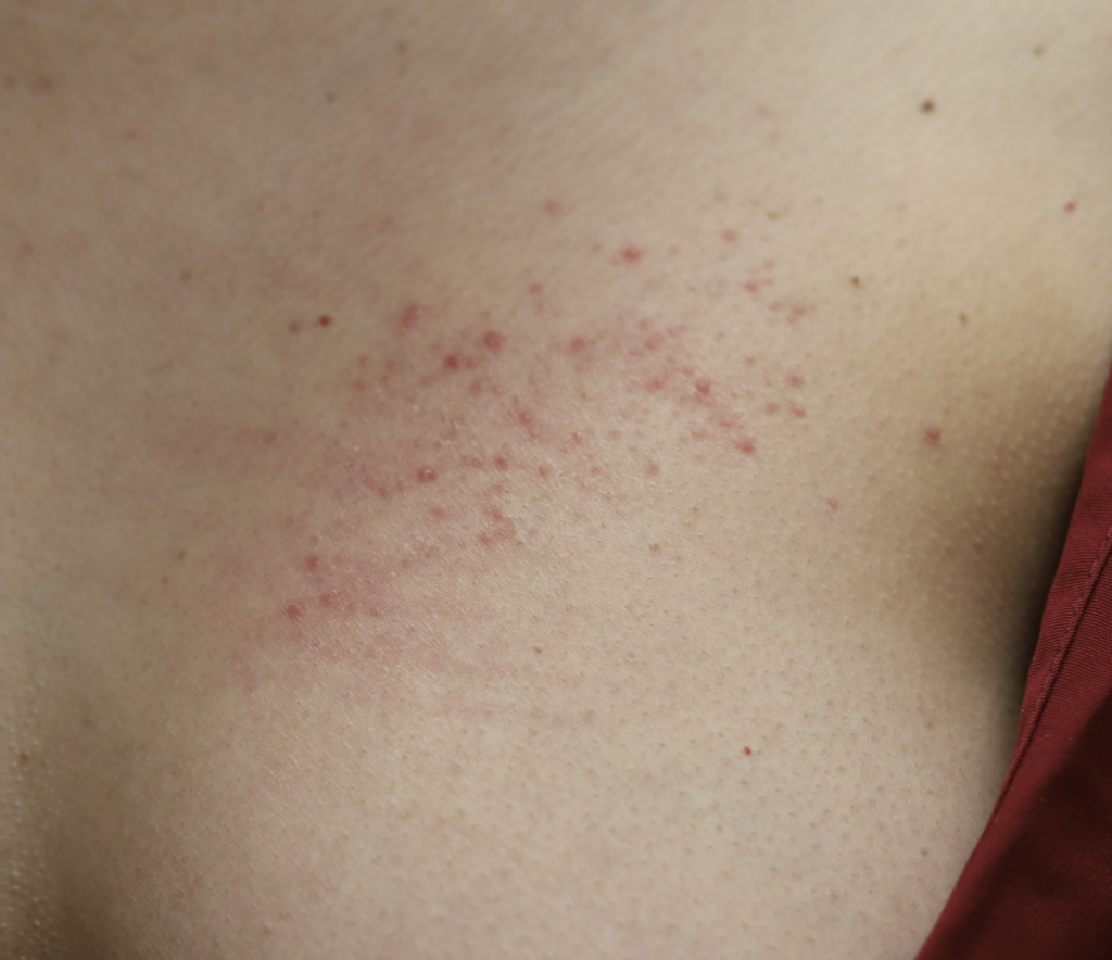 seat belt dermatitis