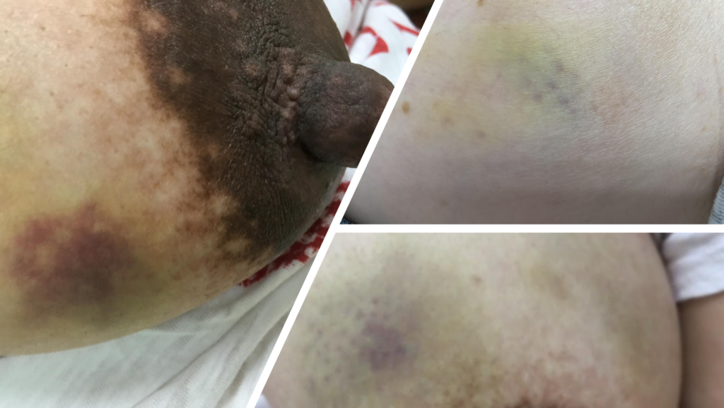 brushing from massage