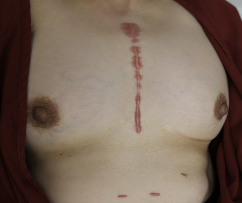 keloids from open heart surgery