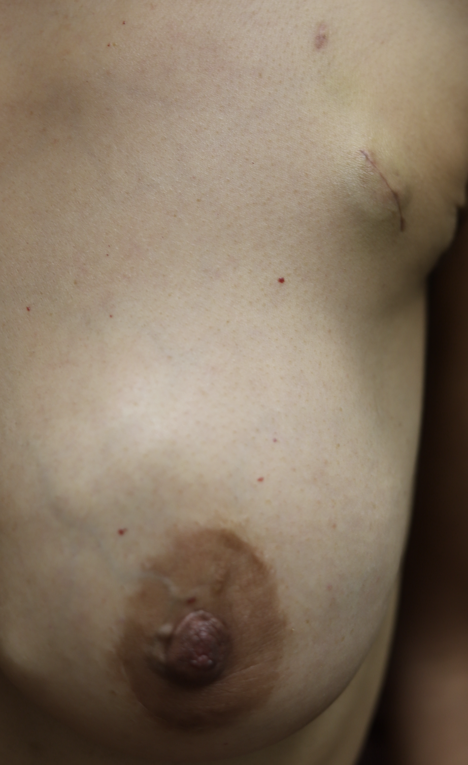 Cosmetic port placement