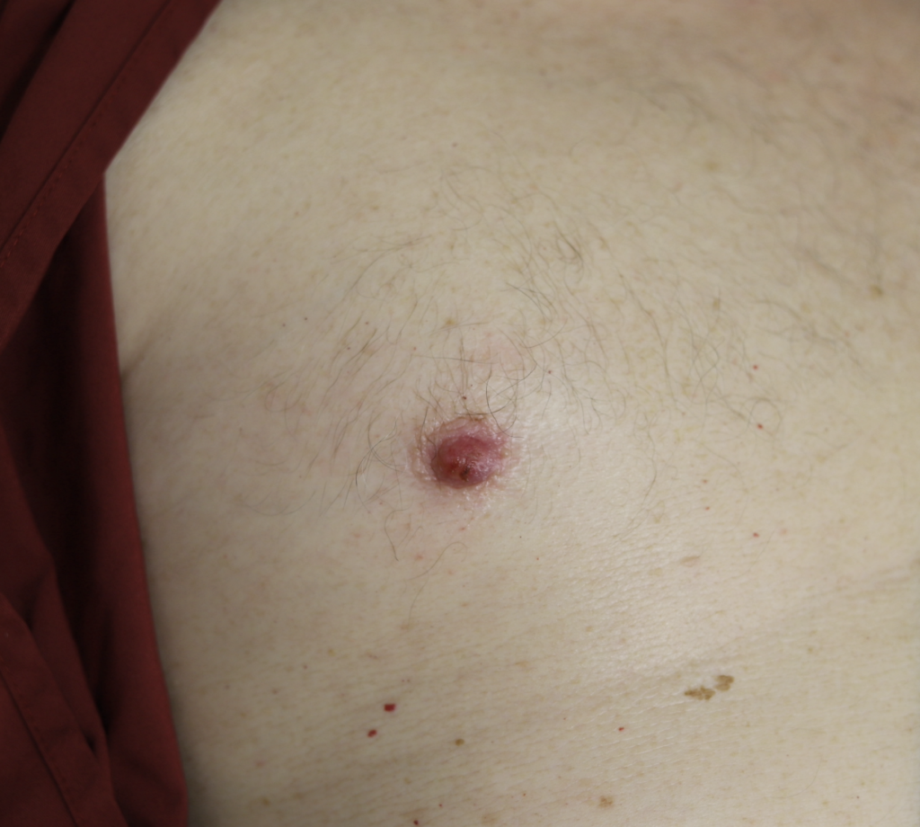 Male breast cancer with red, firm mass in right nipple