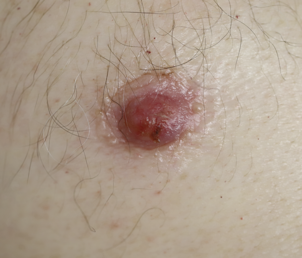 Male breast cancer with red, firm mass in right nipple