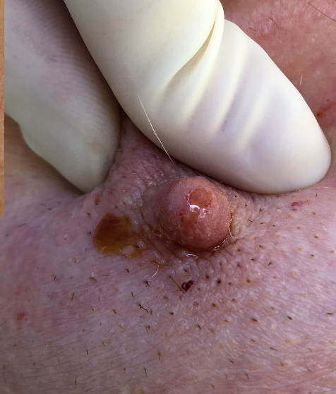 Male breast cancer presenting with bloody discharge.