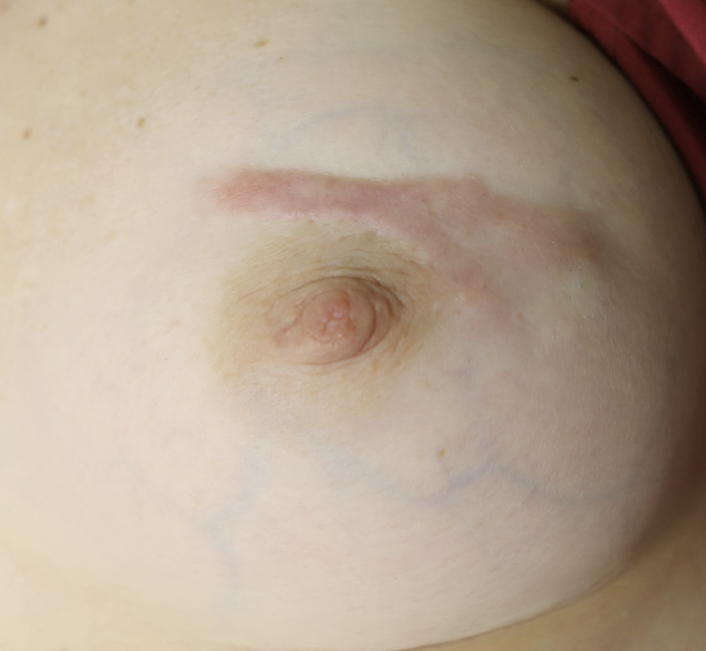 keloid breast