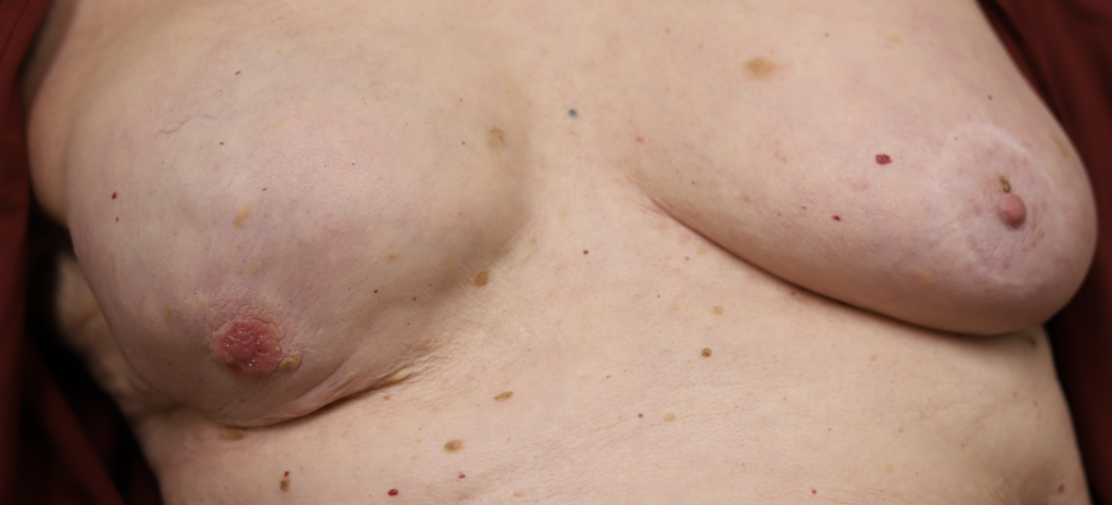 Paget's disease right nipple