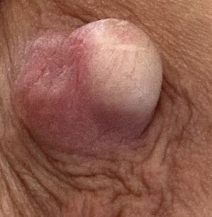 sebaceous cyst
