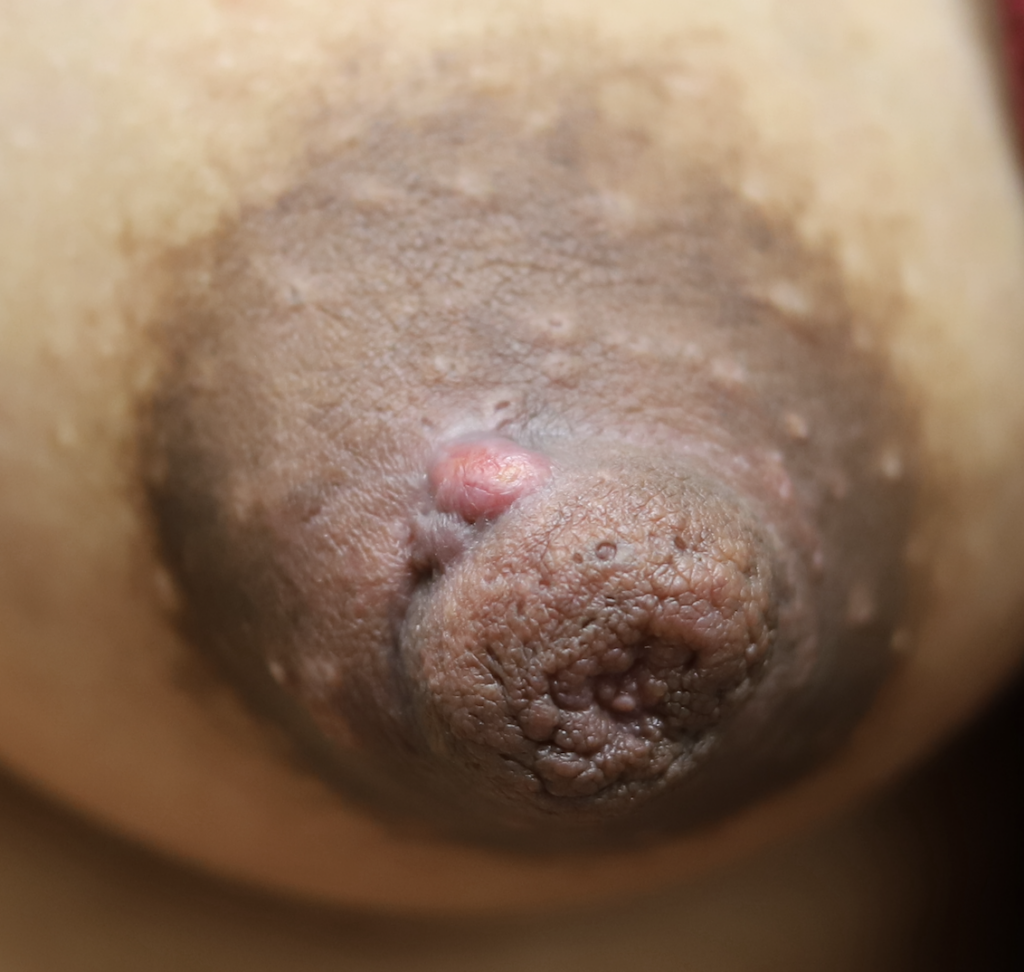 sebaceous cyst