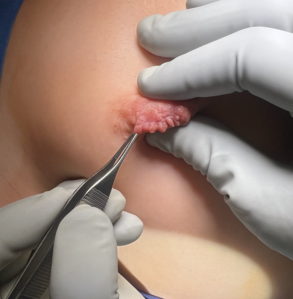 Multiple skin tags adjacent to each other ready for excision in the OR.