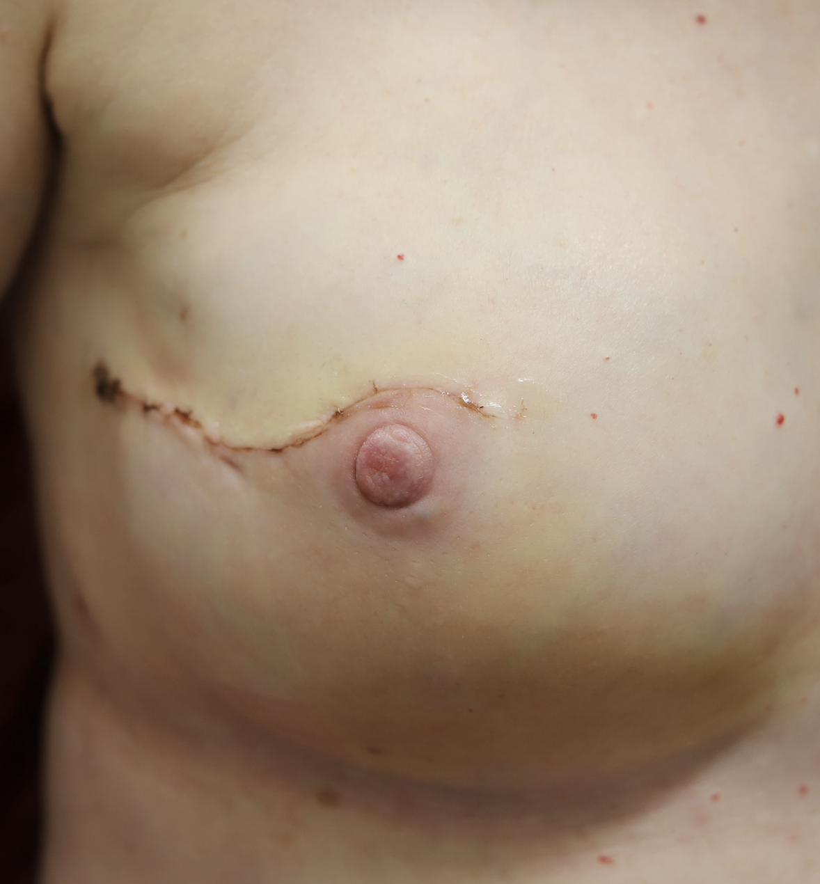 nipple sparing mastectomy