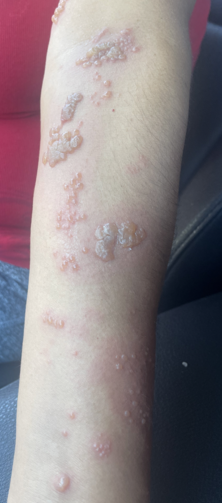 Early shingles left forearm