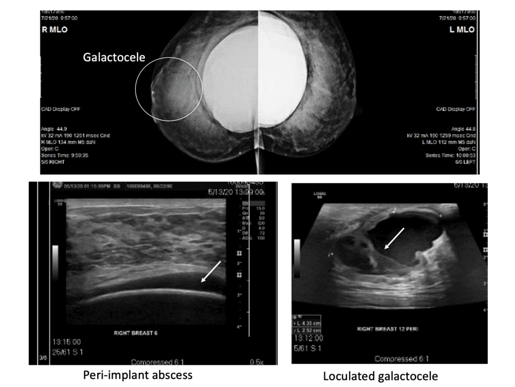 infected breast implant in lactation