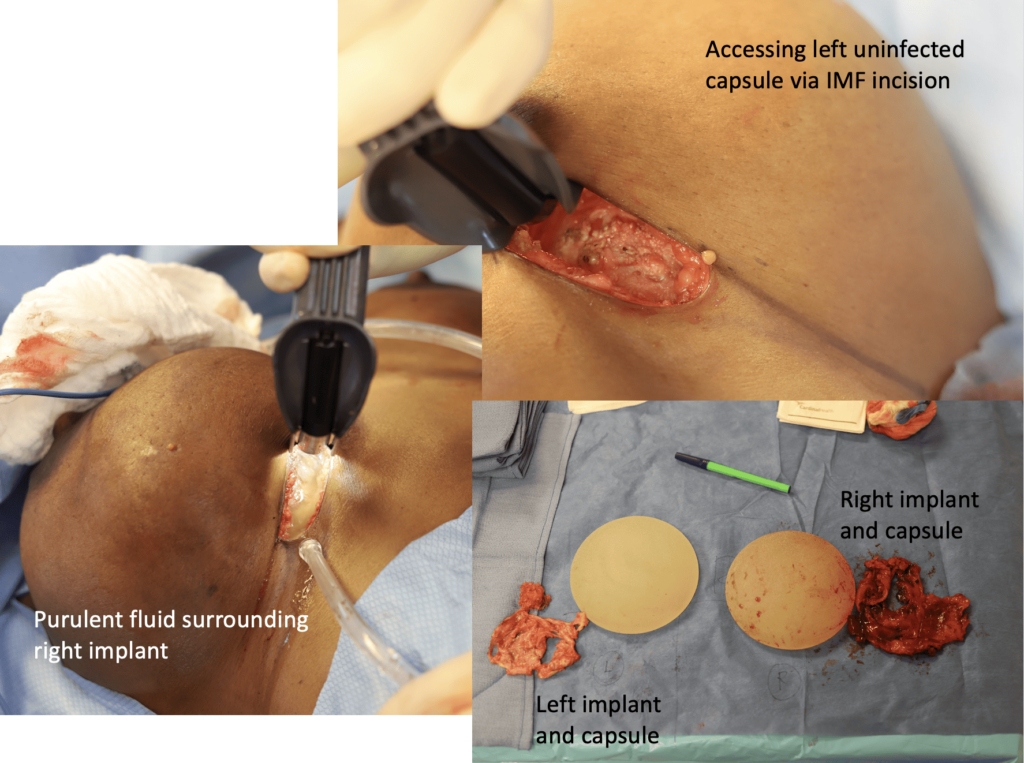infected breast implant in lactation