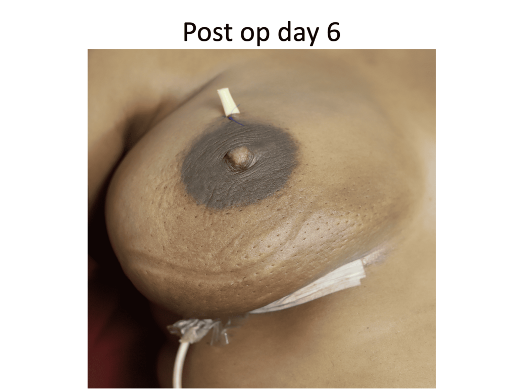 infected breast implant in lactation