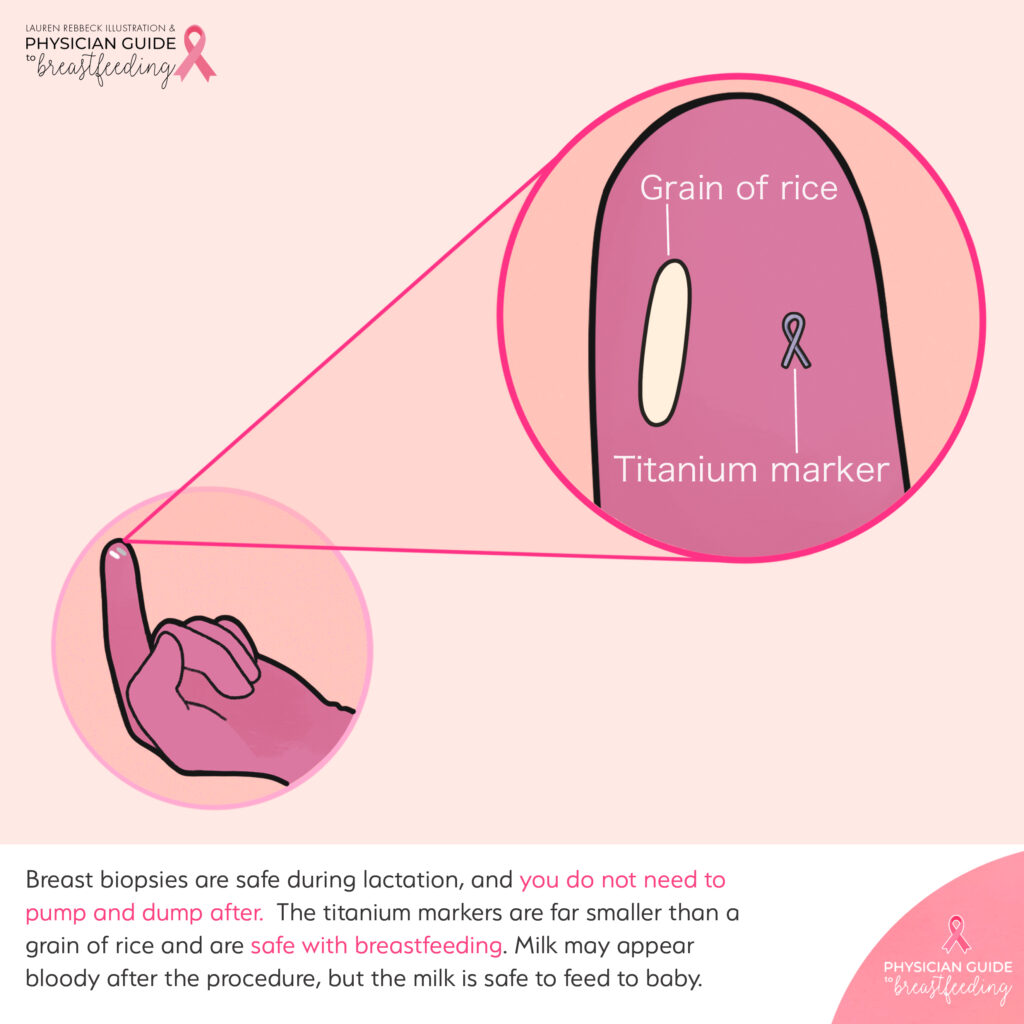 Breast biopsy when breastfeeding