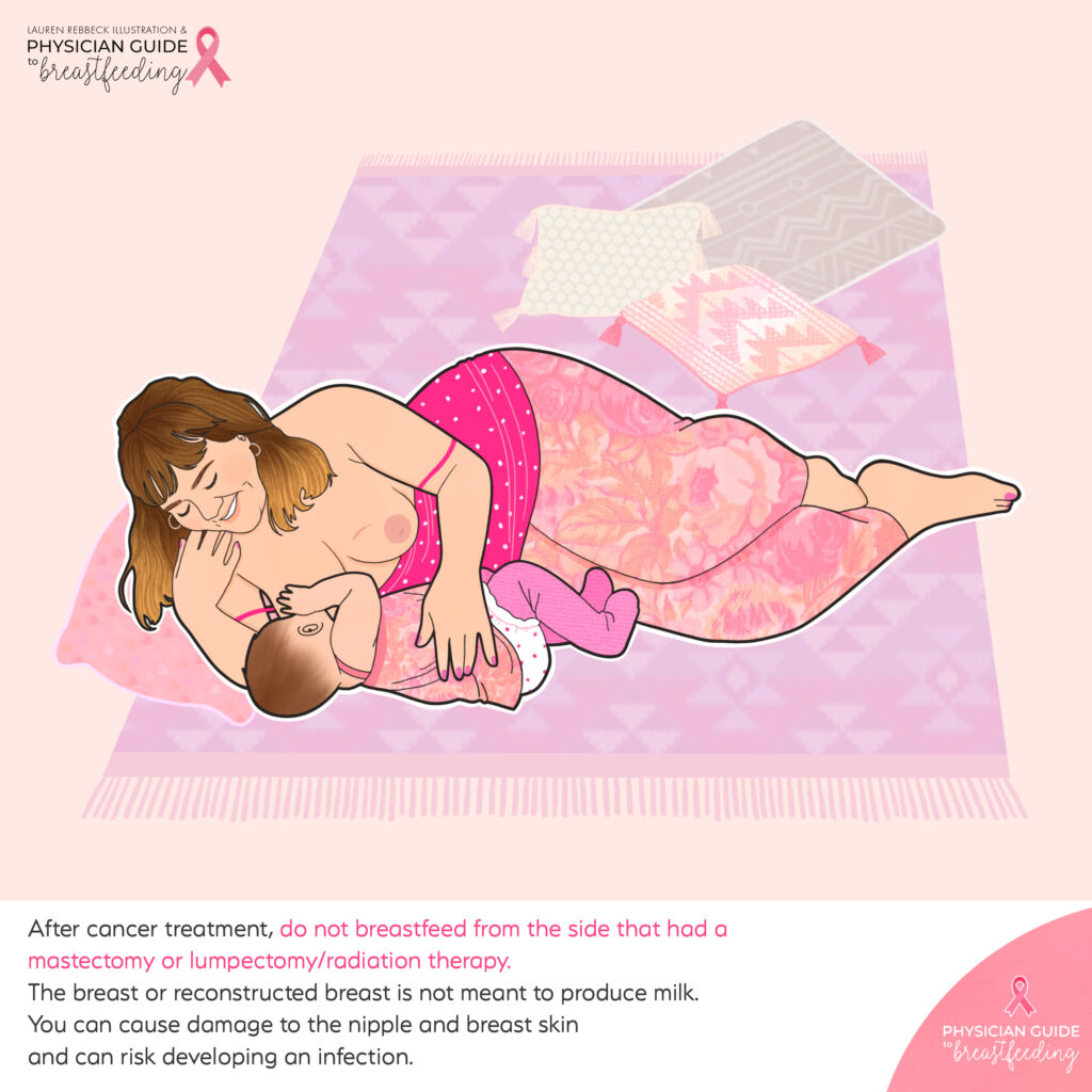 breastfeeding after breast cancer