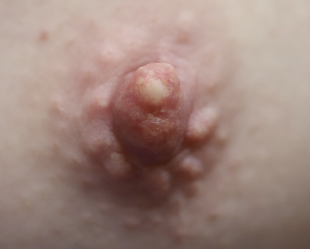 nipple sebaceous cyst