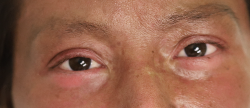 Dermatomyositis in breast cancer