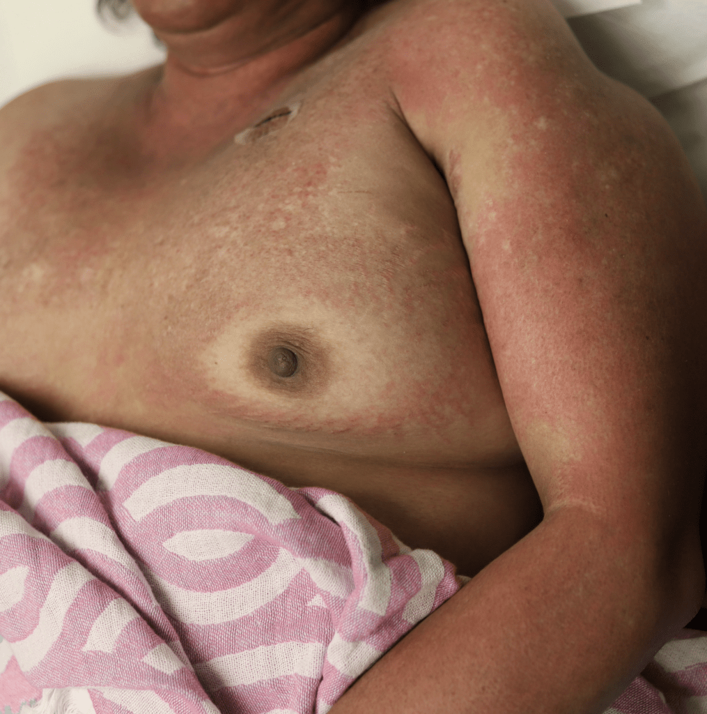 Dermatomyositis in breast cancer