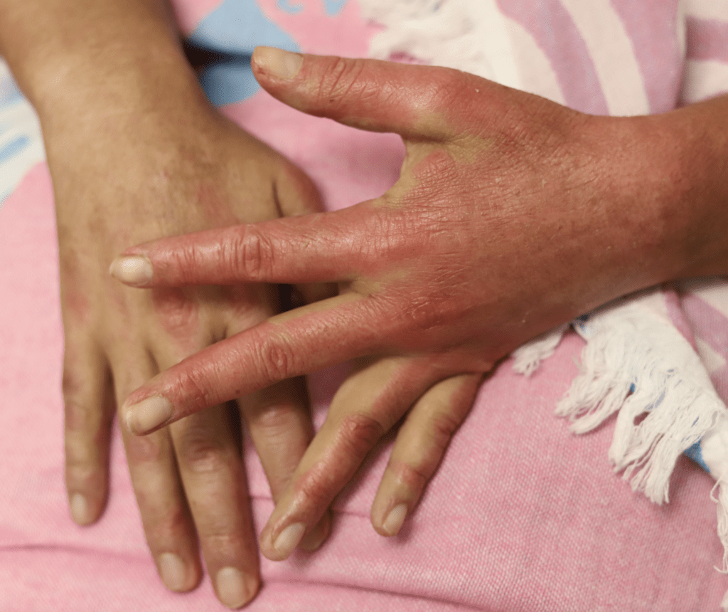 Dermatomyositis in breast cancer