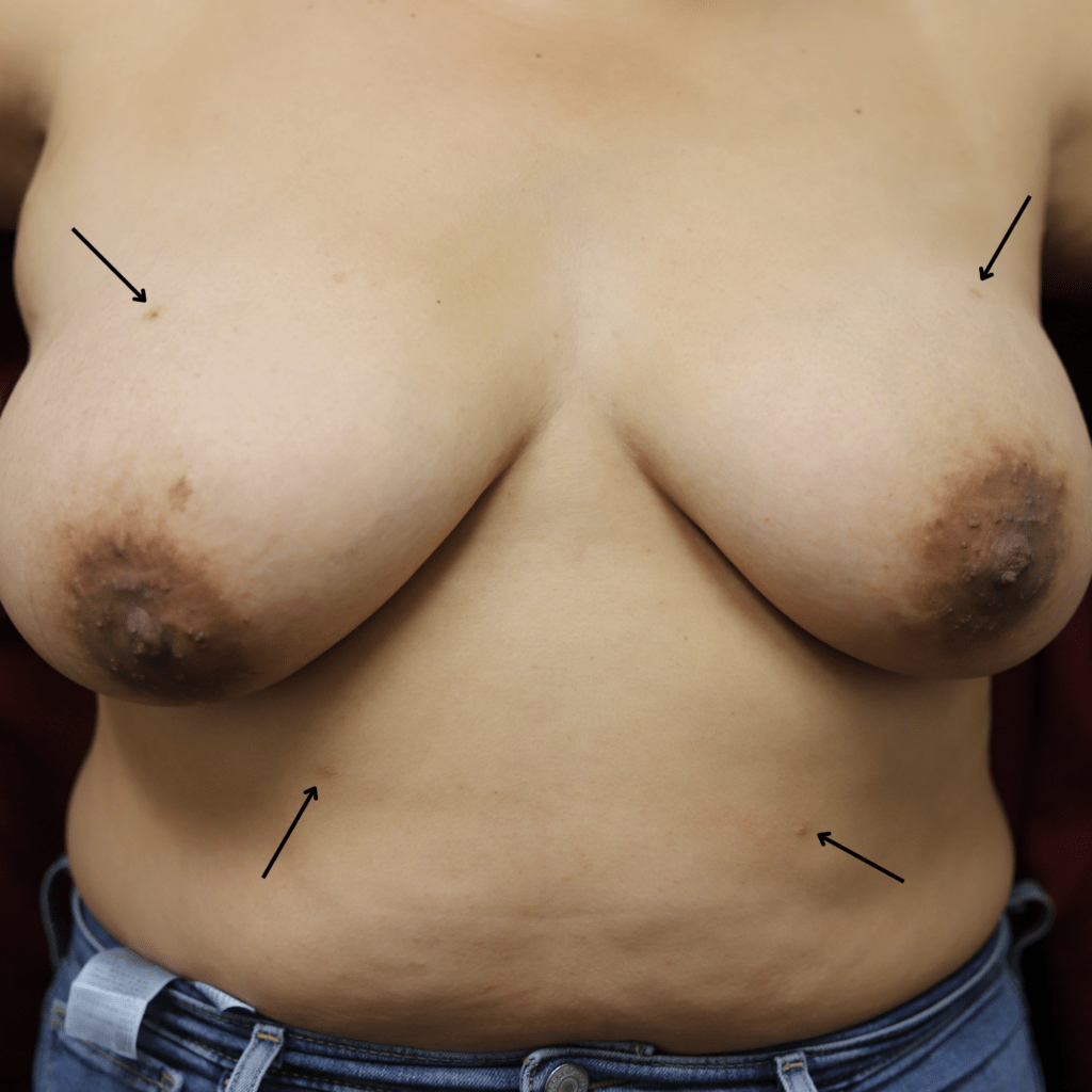 This patient had bilateral symmetric accessory nipples (three on each side!)