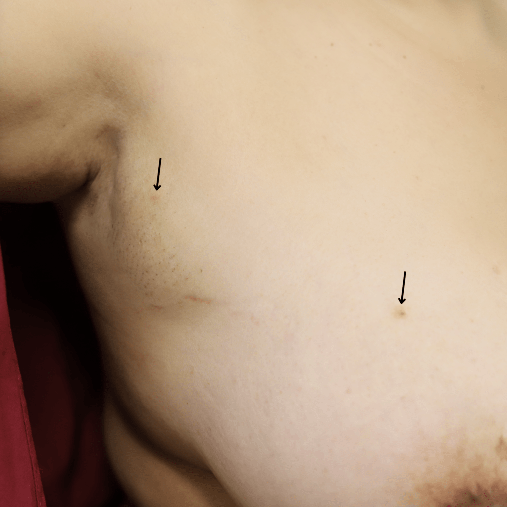Accessory nipple with accessory breast tissue.