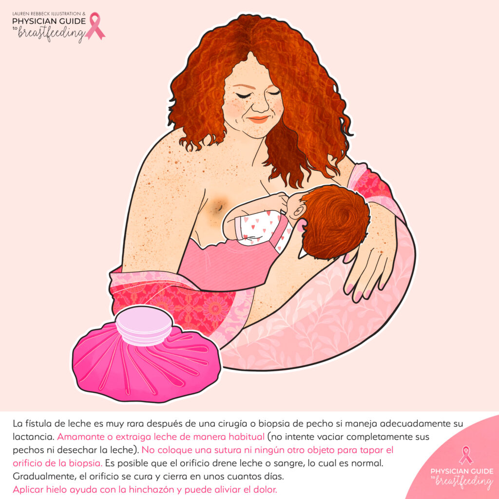 Oncolactation Spanish