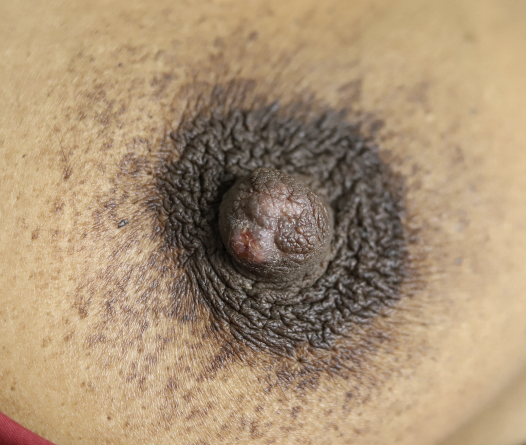 nipple sebaceous cyst