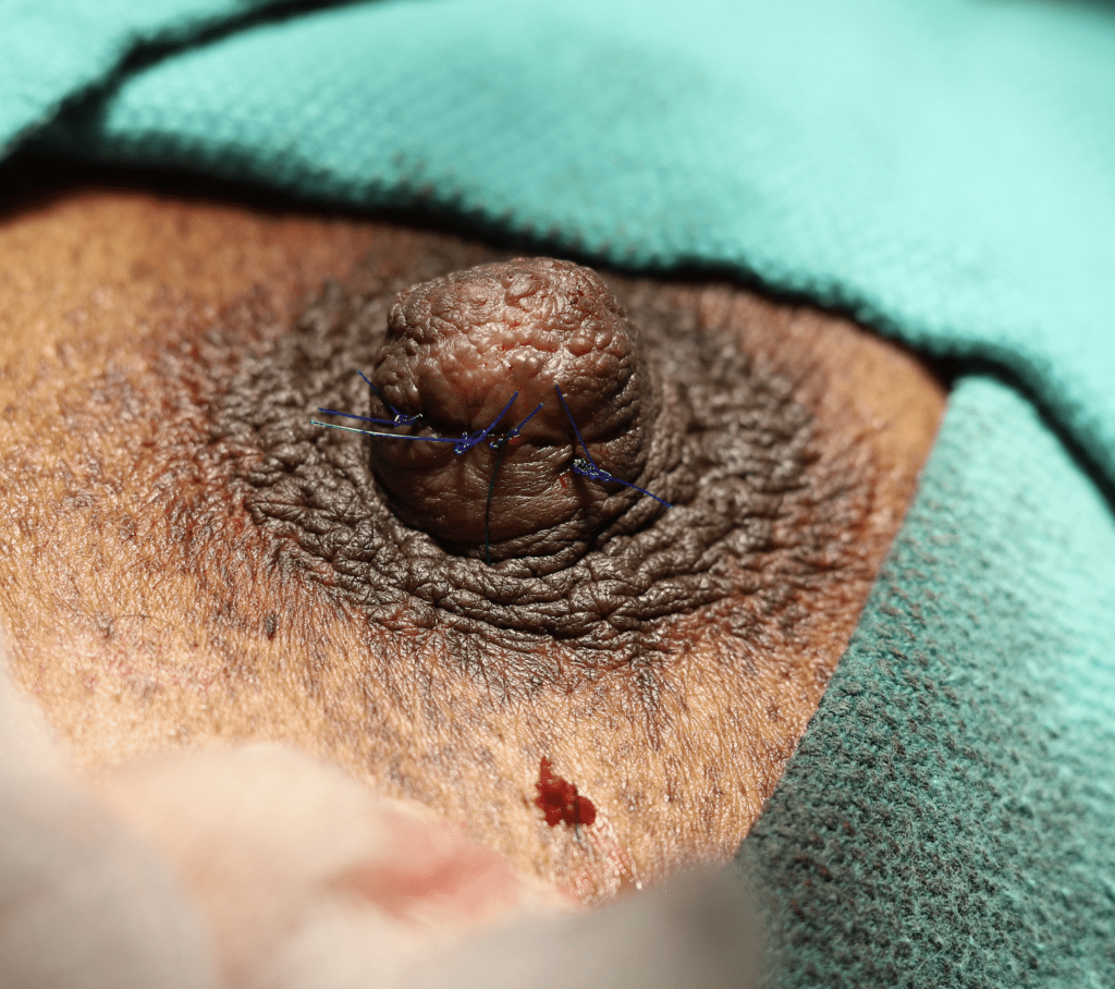 Nipple sebaceous cyst