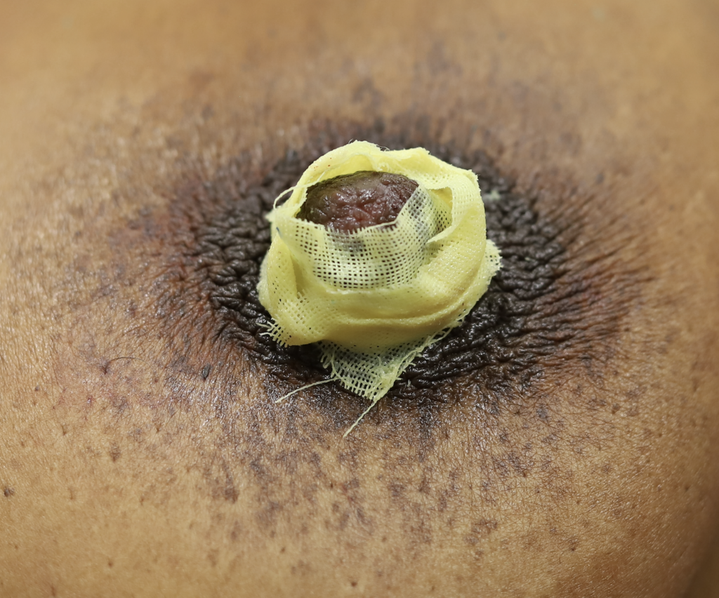 Nipple sebaceous cyst