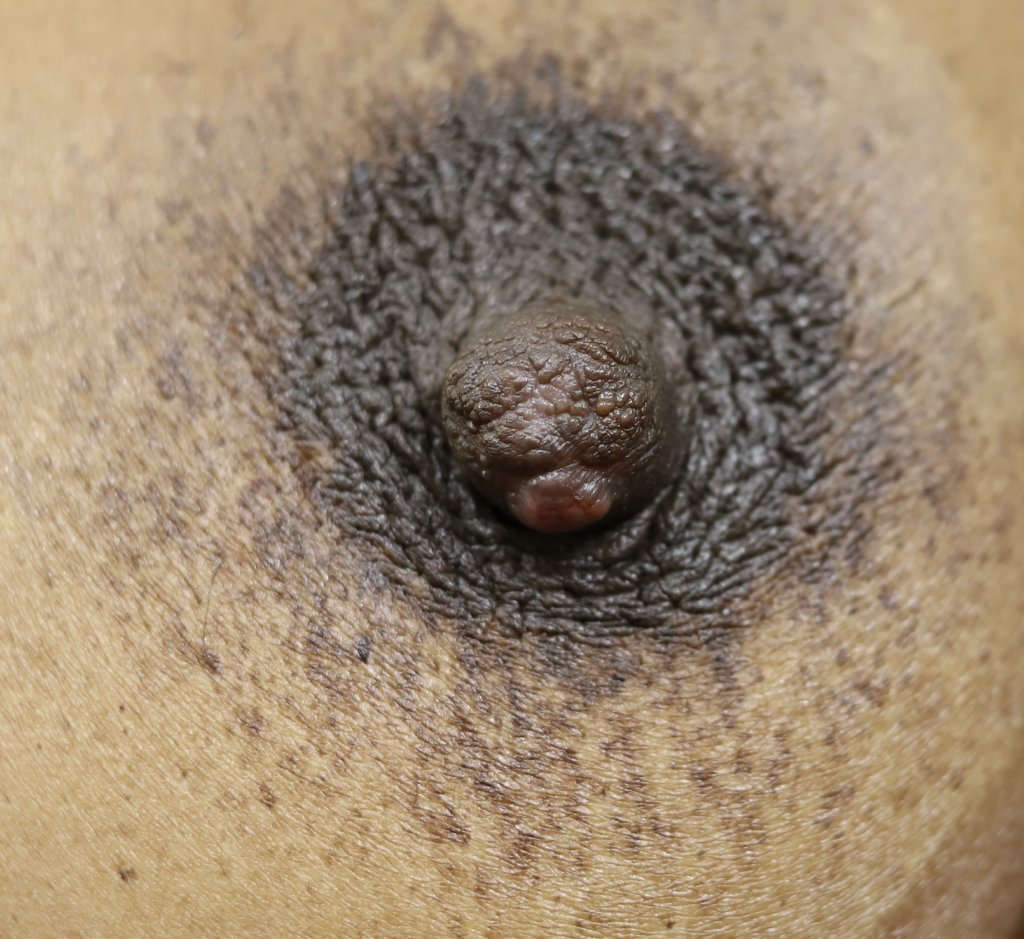 Nipple sebaceous cyst