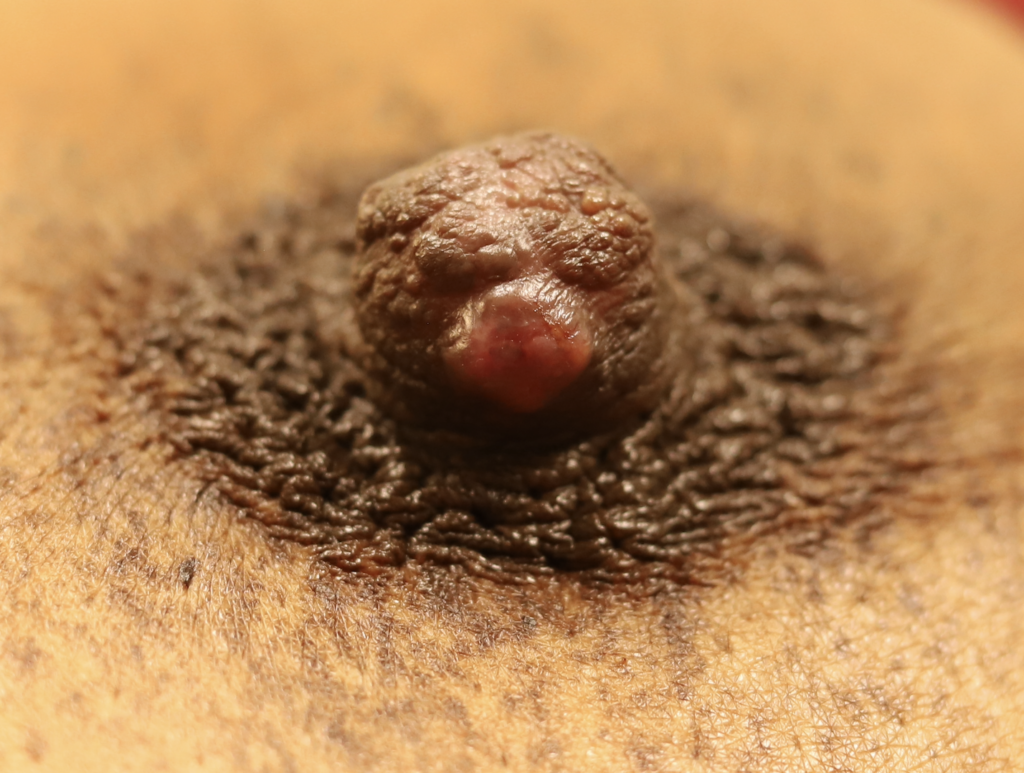 The fact that the cyst is on the shaft of the nipple and not the face confirms sebaceous cyst rather than nipple bleb.