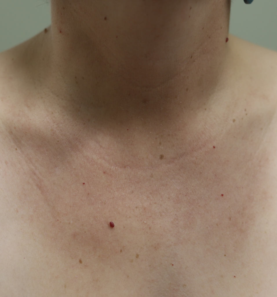 Hives completely resolved after one acupuncture treatment