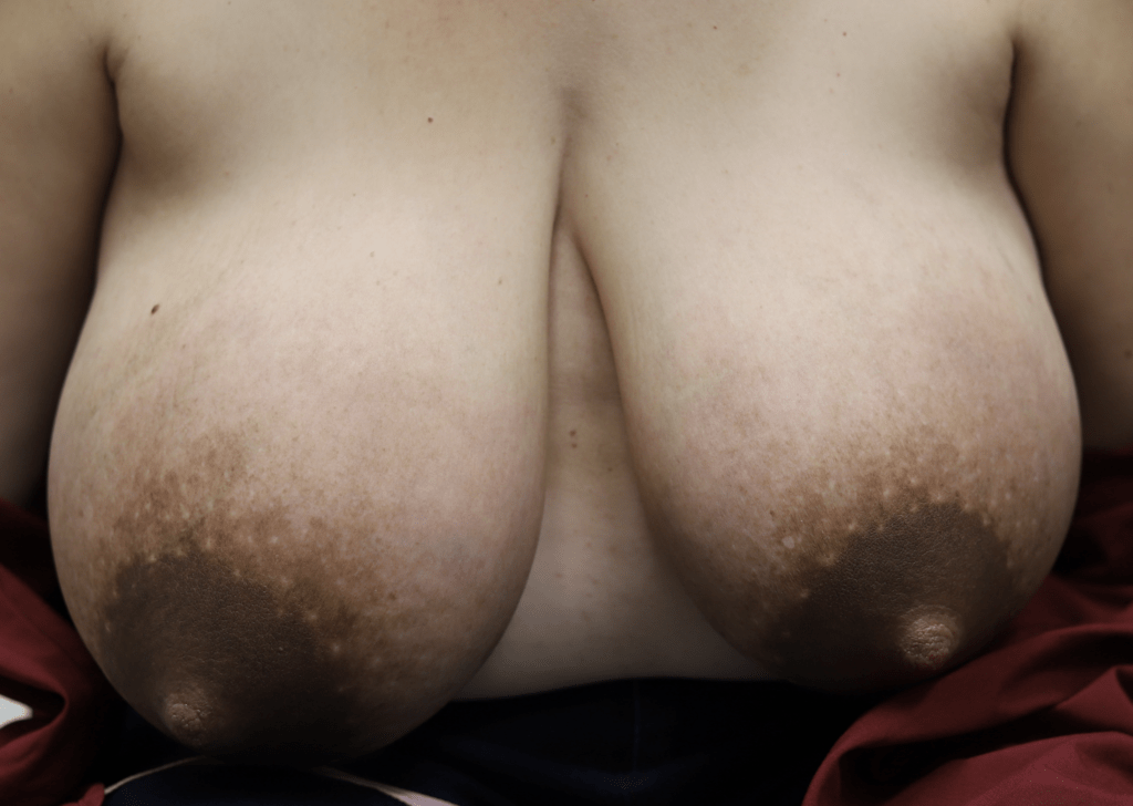 Hives completely resolved after one acupuncture treatment!