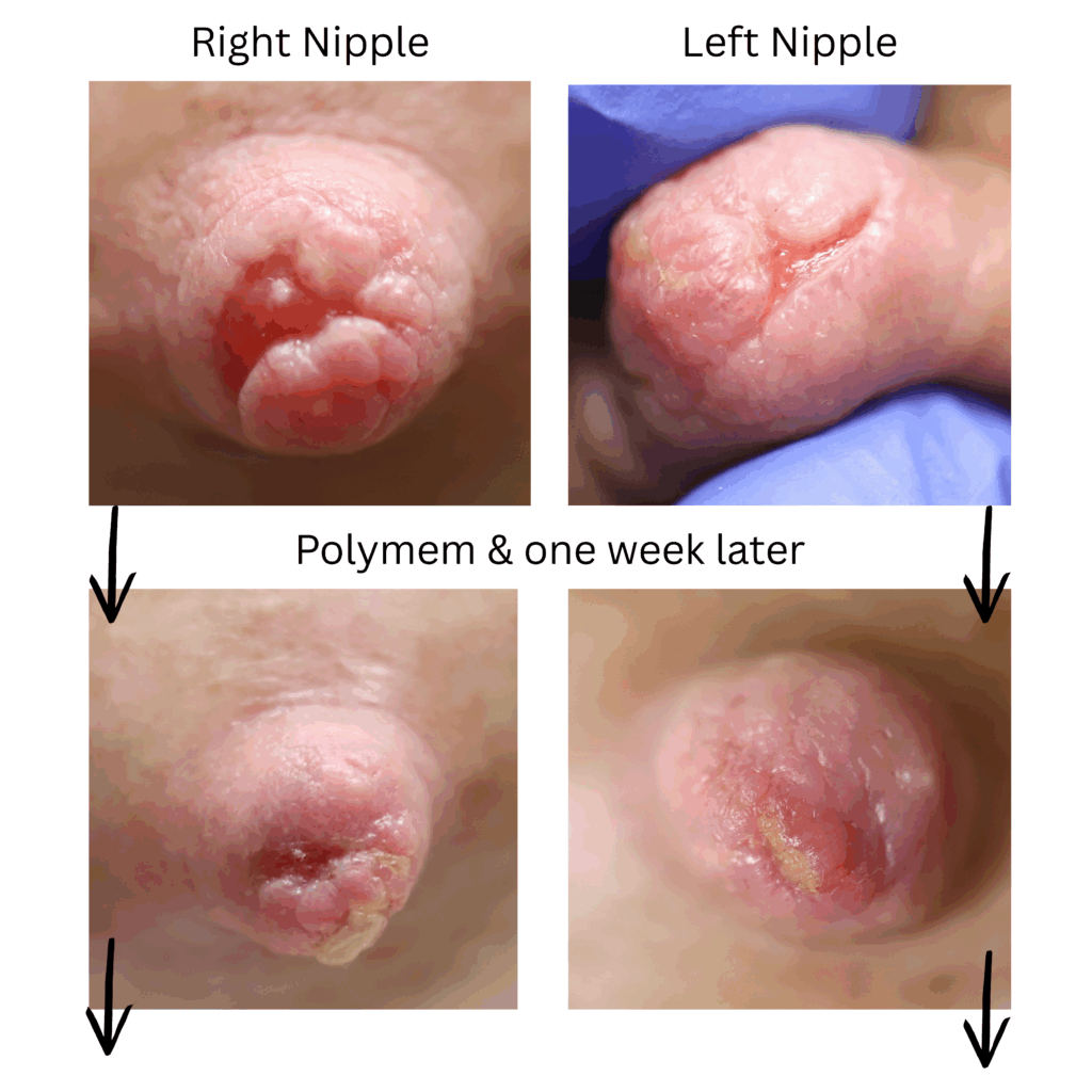 Wound healing nipple