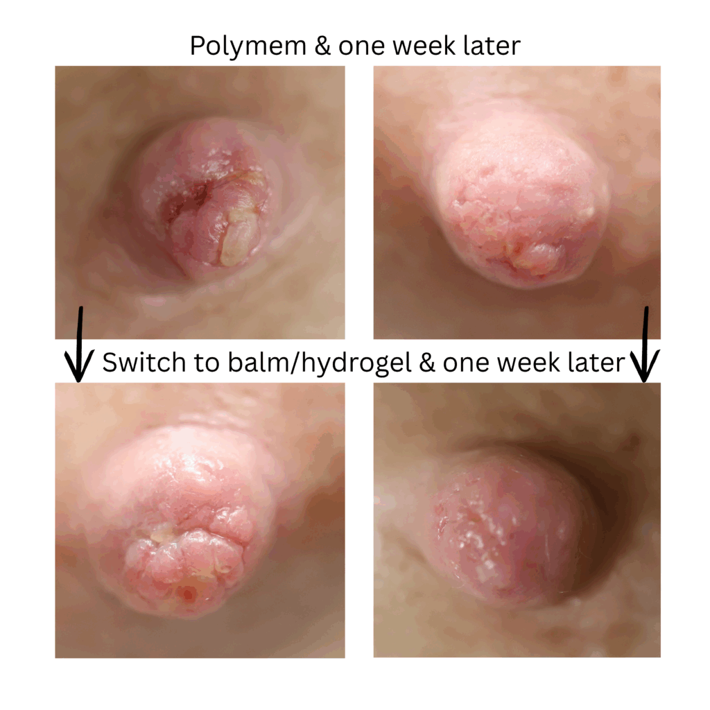 Wound healing nipple