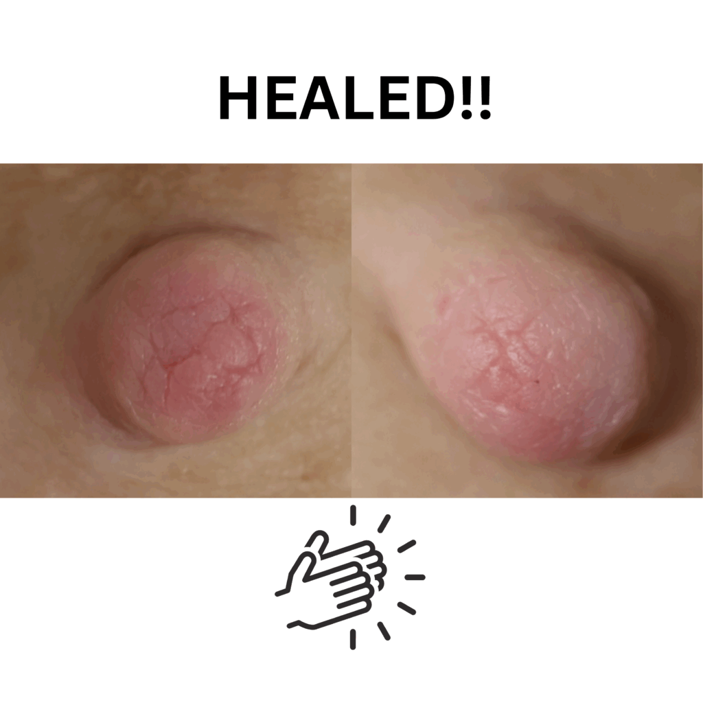 Wound healing nipple