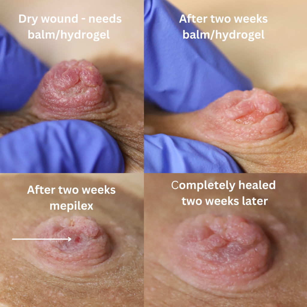 Nipple wound care